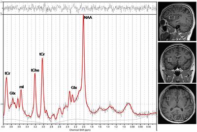 Metabolic alterations in the right anterior insula among patients with cirrhosis without overt hepatic encephalopathy: a magnetic resonance spectroscopy study